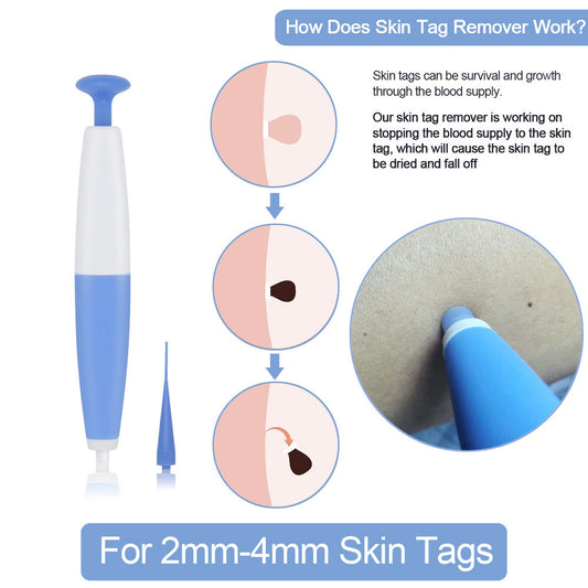 Skin Tag Removal Kit Mole Wart Remover