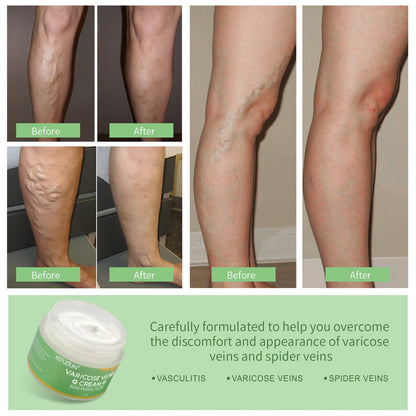 Varicose Vein Relief Cream