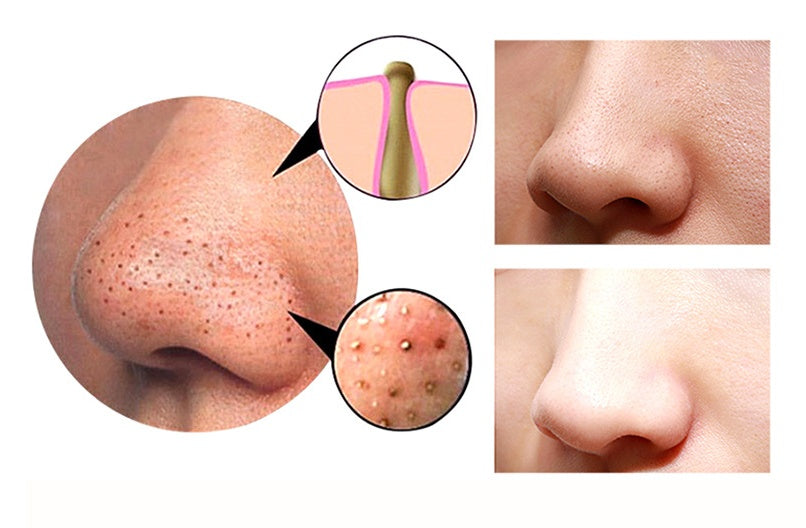 4-in-1 Guasha Cupping Blackhead Remover