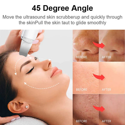 Ultrasonic Skin Scrubber for Deep Blackhead Removal