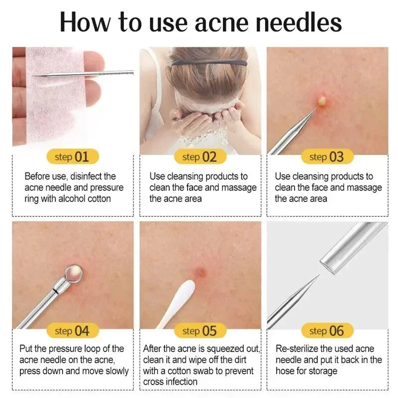 11‑Piece Ultra‑Fine Acne & Blackhead Tweezers Set