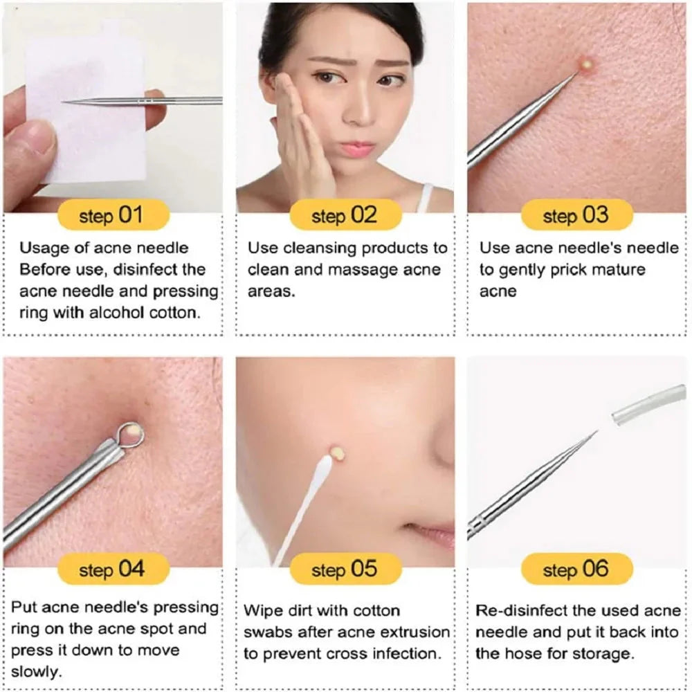 Stainless Steel Blackhead & Whitehead Extractor Kit