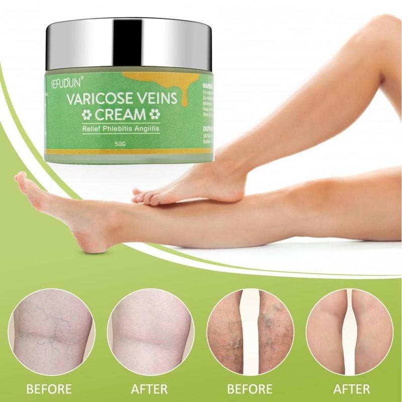 Varicose Vein Relief Cream